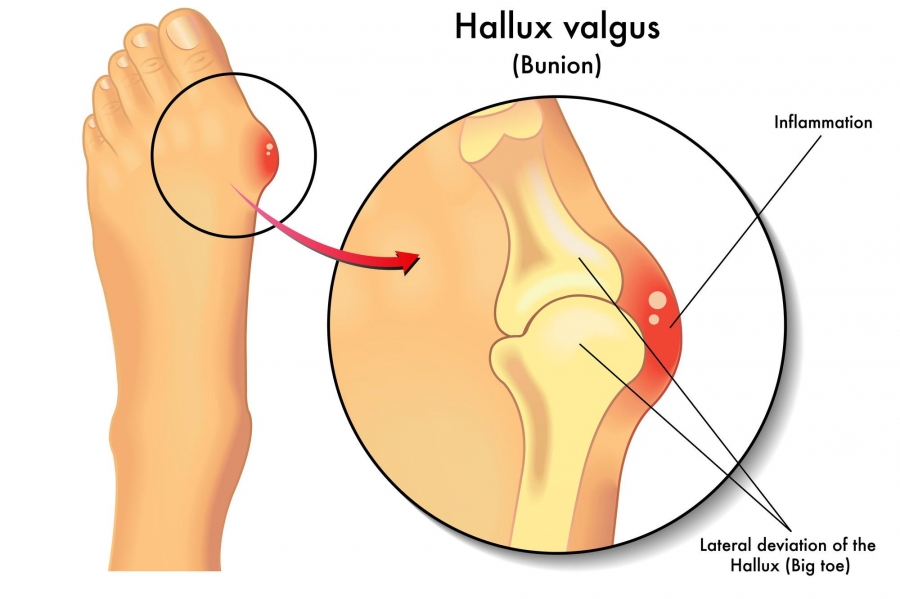 What Really Causes Bunions?